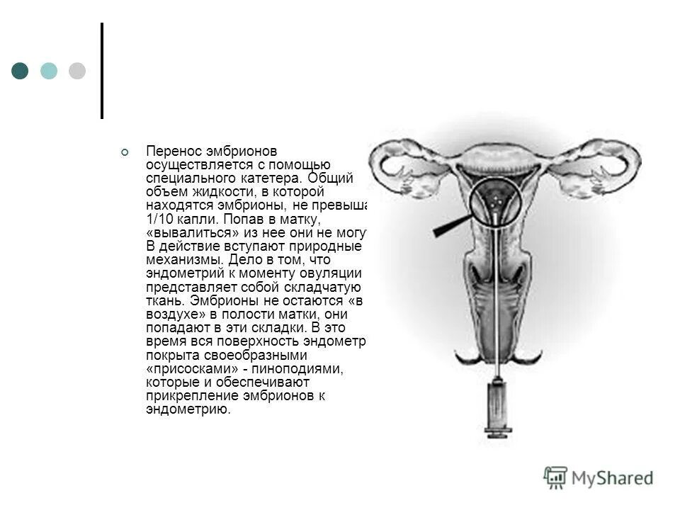Эндометрий при переносе эмбриона. Перенос эмбриона в матку. Перенос эмбрионов в полость матки. Катетер для подсадки эмбриона в полость матки. Катетер при переносе эмбрионов.