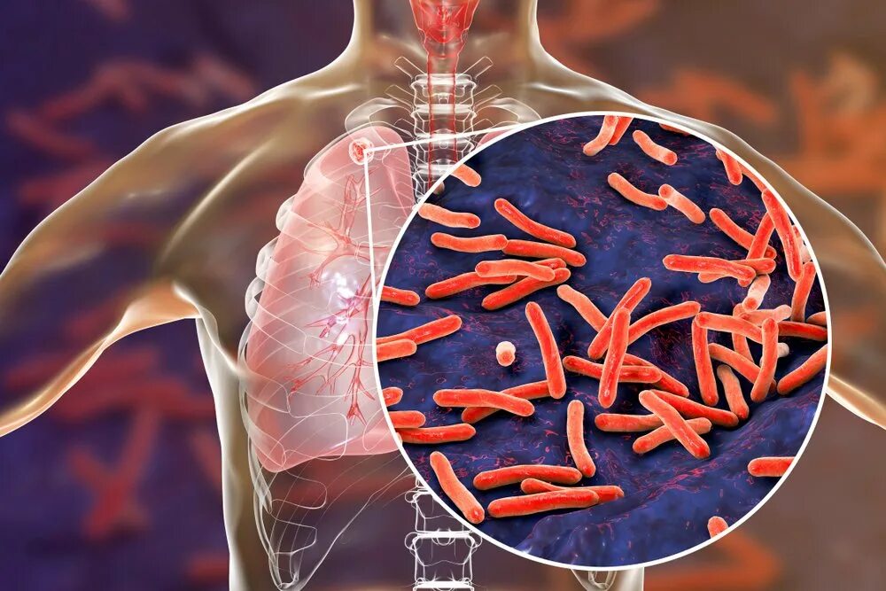 Туберкулез заболевание вызываемые бактериями. Бактерия mycobacterium tuberculosis. микобактерии туберкулеза в легких. туберкулез бактериальное заболевание. палочка коха mycobacterium tuberculosis.