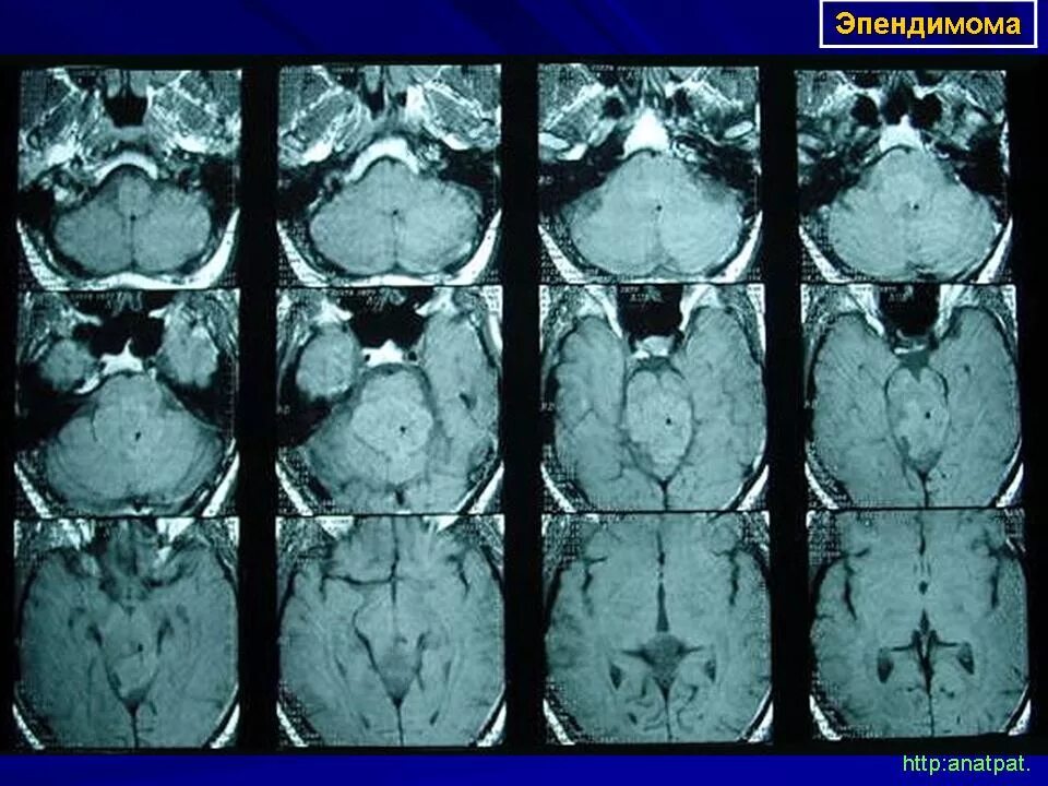 Эпендимома спинного. Эпендимома головного мозга мрт. Эпендимома спинного мозга. Эпендимома 4 желудочка кт. Эпендимома головного мозга кт.