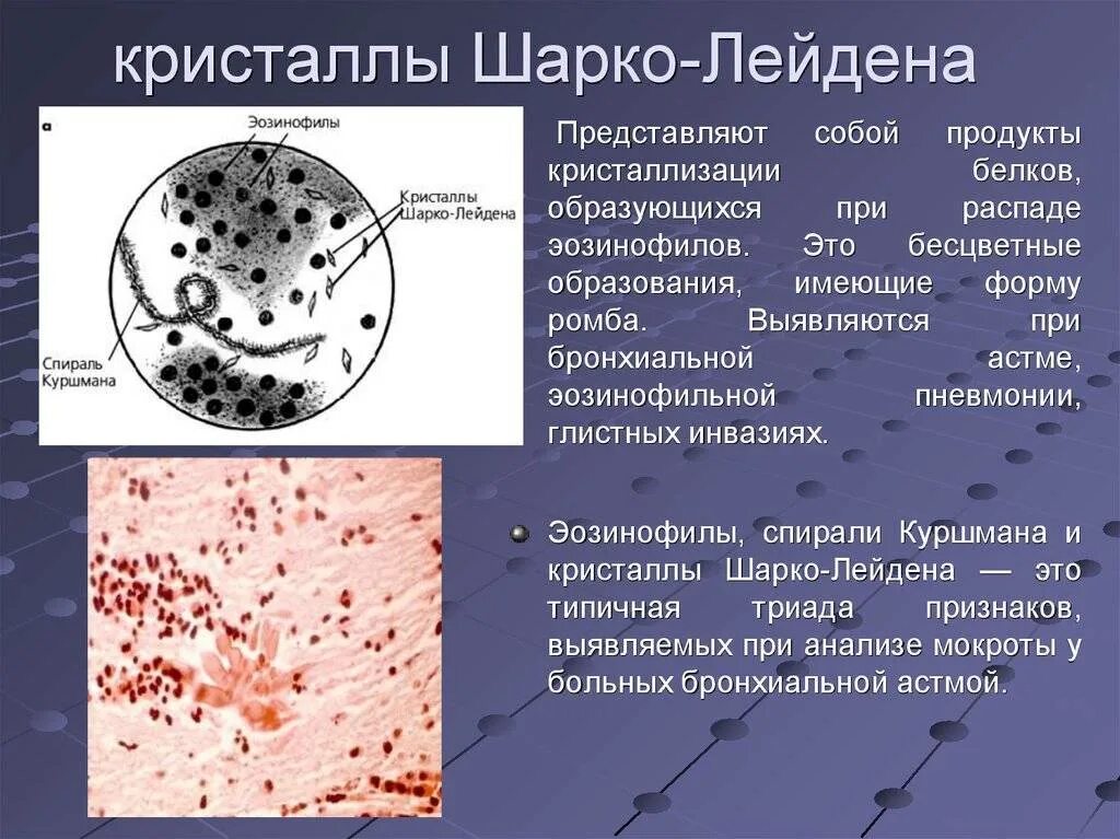 Шарко кале. Спирали Куршмана и Кристаллы Шарко-Лейдена. Спирали Куршмана и Кристаллы Шарко-Лейдена в мокроте. Кристаллы Шарко Лейдена. Спирали Куршмана, Кристаллы Шарко-Лейдена, эозинофилы.