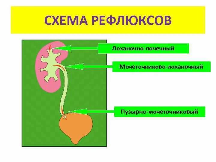 Рефлюкс мочеточника. Пузырно-мочеточниково-лоханочный рефлюкс (ПМР). Пузырно мочеточниково лоханочный рефлюкс у детей. Лоханочно почечный рефлюкс это. Пузырно-мочеточниковый рефлюкс пассивный.