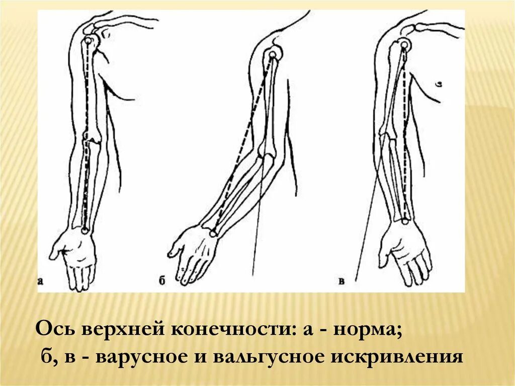 Операции верхних конечностей. Деформация локтевого сустава вальгус. Вальгусная деформация верхней конечности. Варусная деформация верхней конечности. Измерение оси верхней конечности травматология.