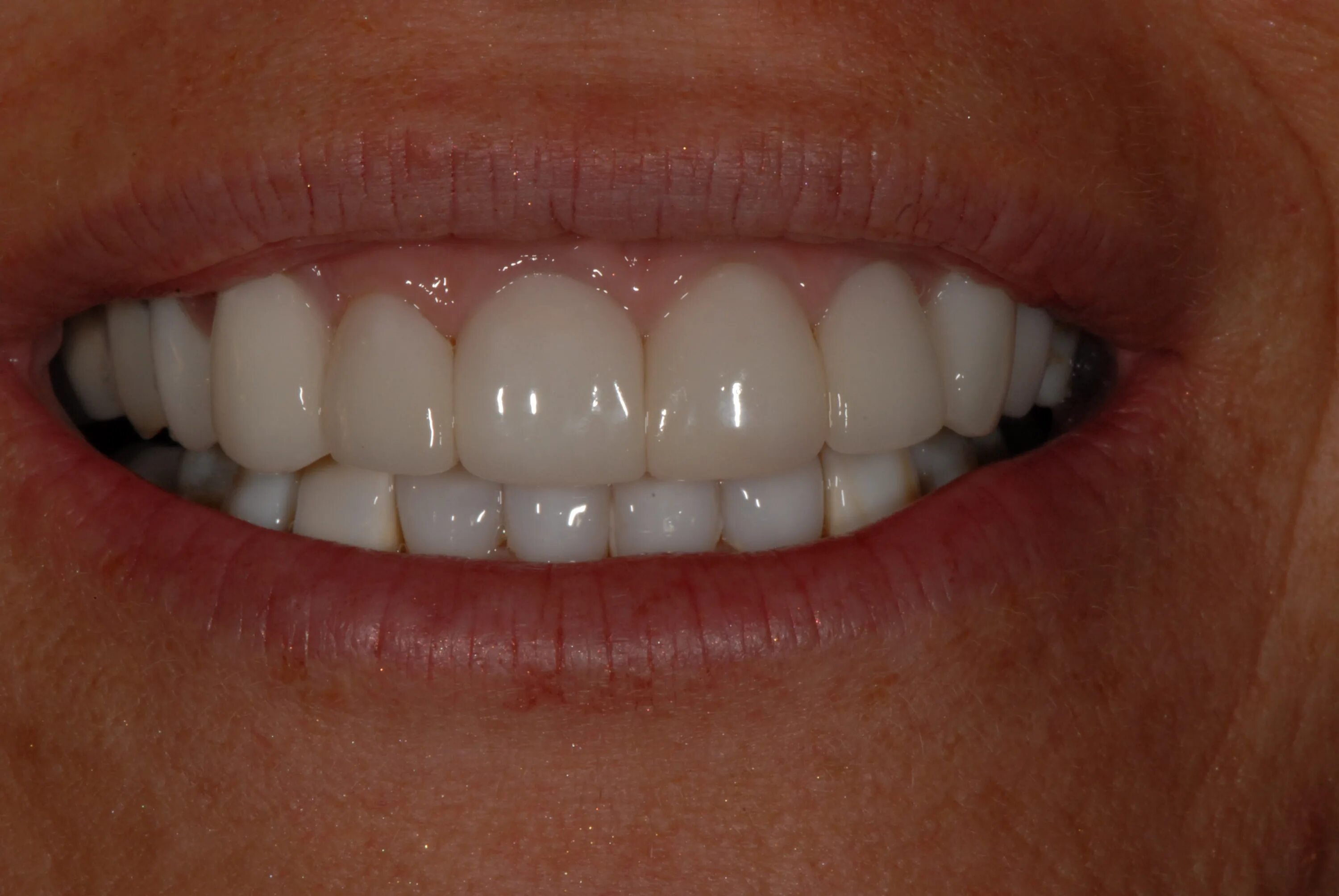 голливудская улыбка коронки. композитные виниры улыбка. виниры улыбка. керамические виниры 1м1. композитные виниры bleach 4.