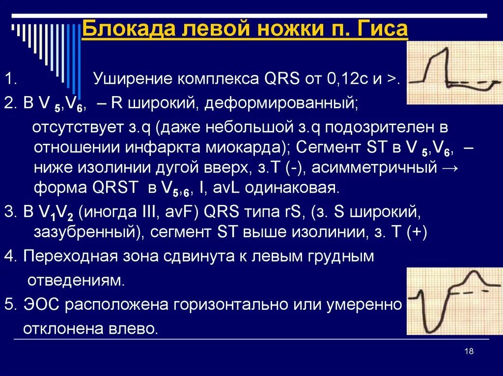 Блокада левой ножки п гиса. Уширение комплекса QRS. Комплекс QRS при блокаде ножек. При блокаде левой ножки QRS меха.