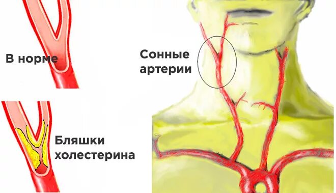 Бца (брахиоцефальные артерии). Холестериновая бляшка в сонной артерии. Каротидная бифуркация сонной артерии. Брахиоцефальные артерии, сосуды (бца). Бляшка на шее операция