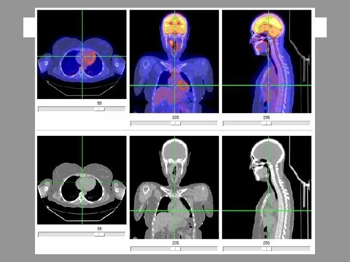 Pet ct. Позитронно-эмиссионная кт. Позитронно-эмиссионная томография (ПЭТ). ПЭТ метод исследования. Аппарат ПЭТ кт.