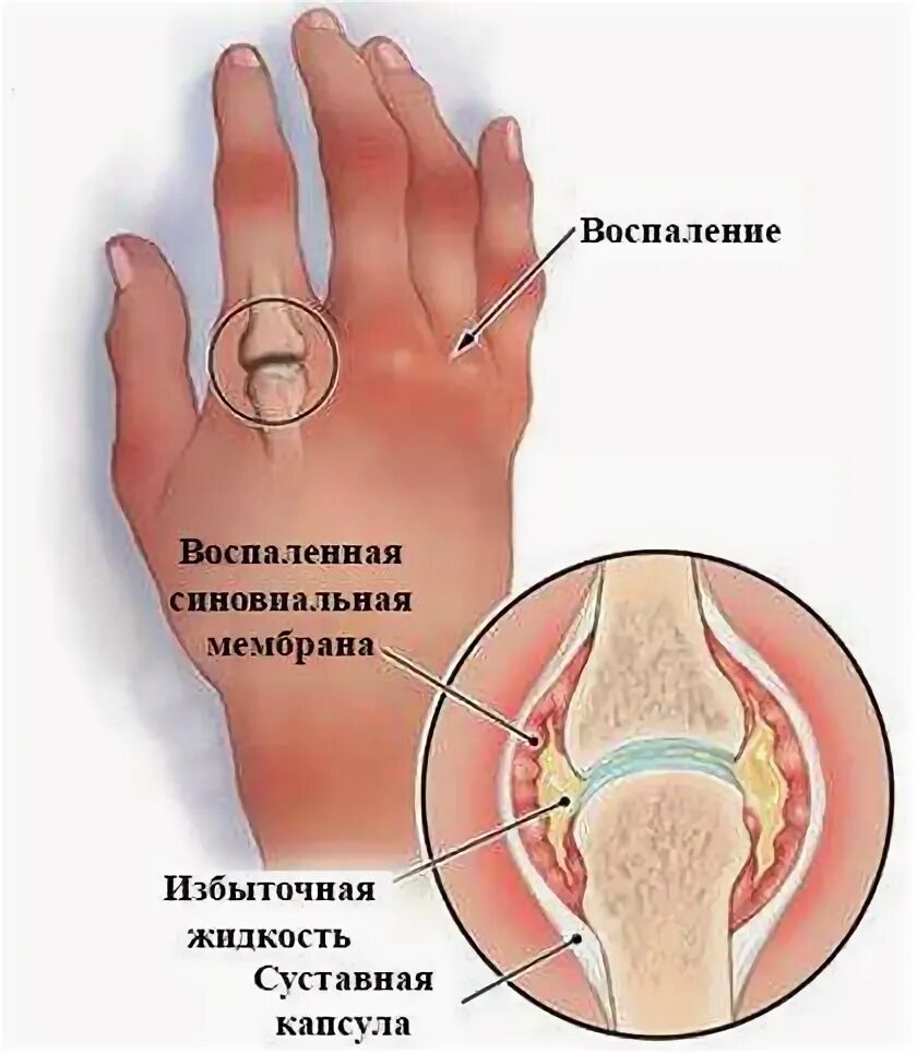 Блуждающая боль. Блуждающая боль в суставах.