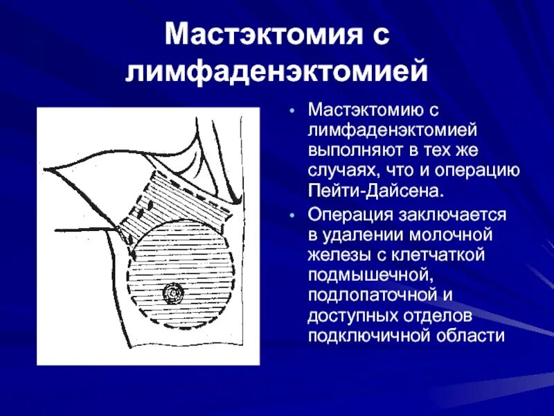 После операции молочной железы и лимфоузлов. Радикальная мастэктомия по пейти-Дайсону. Радикальная мастэктомия молочной железы. Мастэктомия по Маддену операция. Радикальная мастэктомия этапы операции.