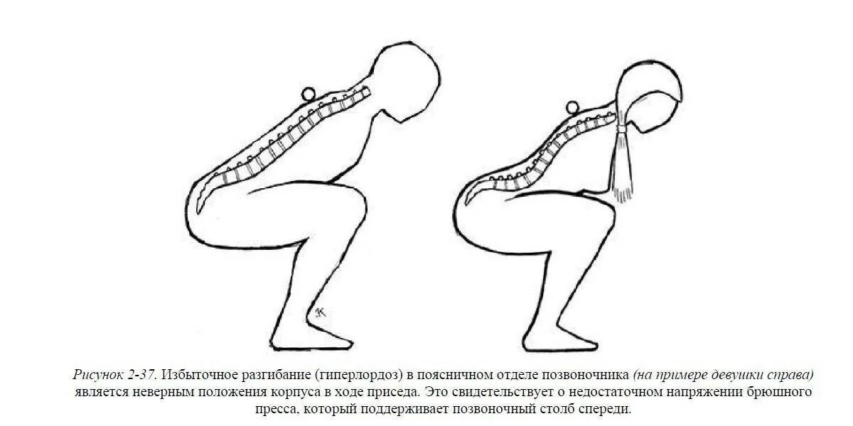 Приседания поясница. Лордоз поясничного отдела позвоночника гимнастика. Лордоз поясничного отдела и гиперлордоз. Лордоз позвоночника упражнения. Поясничный лордоз позвоночника упражнения.