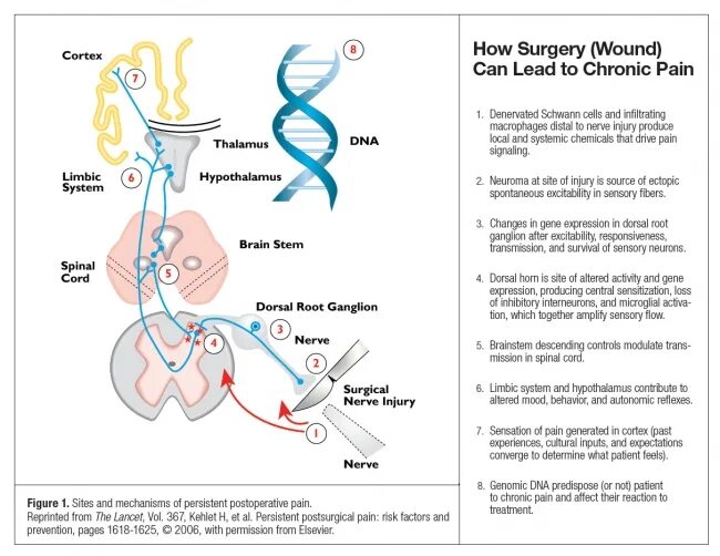 Surgery перевод. Pain mechanism. Chronic Pain. Sensory System Pain. Patient with chronic Pain.