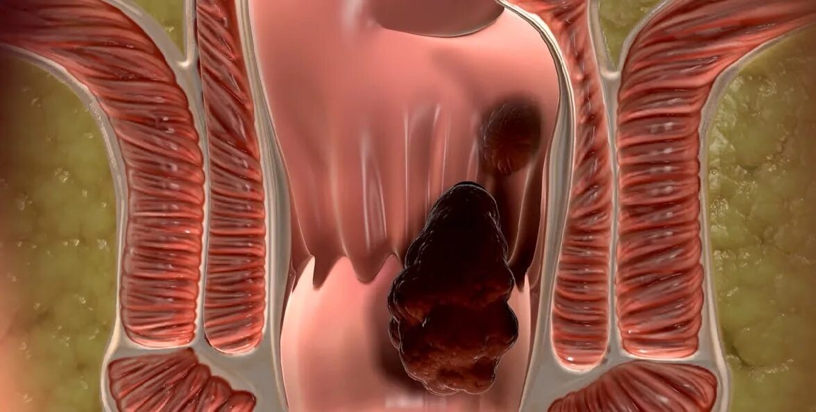 Геморроидальные шишки. Трещина в заднем проходе кровоточит