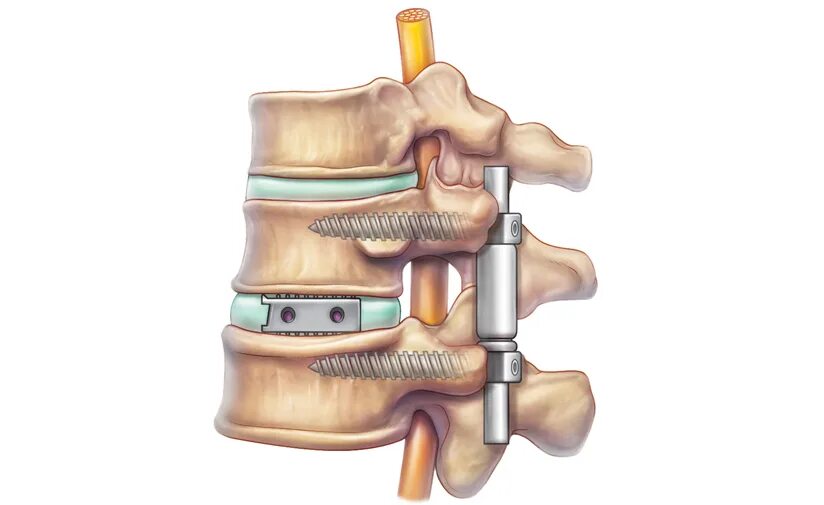 Передний спондилодез Кейджем с5-с6. Дискэктомия с5-с6 корпородез Кейджем. Передний спондилодез поясничного отдела позвоночника операция. Спондилодез поясничного отдела позвоночника Кейджем. Конструкция позвоночника операция