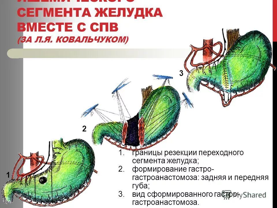 Умер от резекции желудка. Сегменты желудка. Клиновидная резекция желудка. Сегментация желудка.