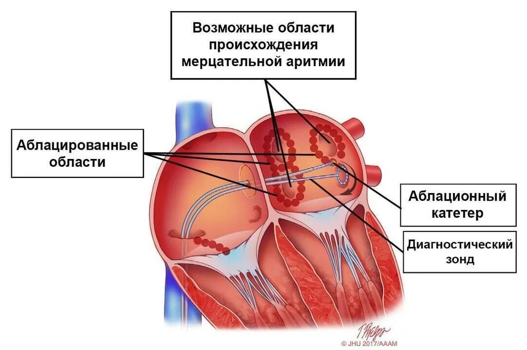 Рча предсердий. Радиочастотная абляция фибрилляции предсердий. Предсердий катетерная абляция. РЧА при трепетании предсердий. РЧА сердца при мерцательной аритмии.