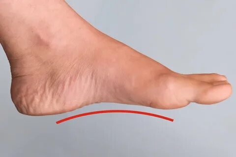 Flat footed