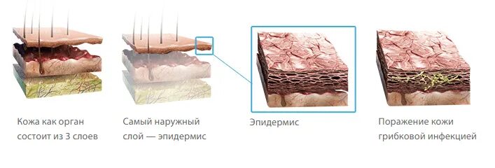 Солнечный ожог 3 степени. Механизм химического пилинга. Повреждение верхних слоев кожи. Повреждение верхних слоев кожи. Повреждение верхних слоев кожи.