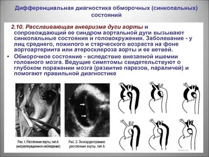 Синкопальное состояние диагностика