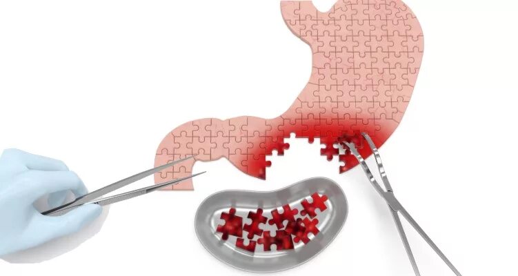 Операция по удалению язвы. Операция удаления опухоли желудка