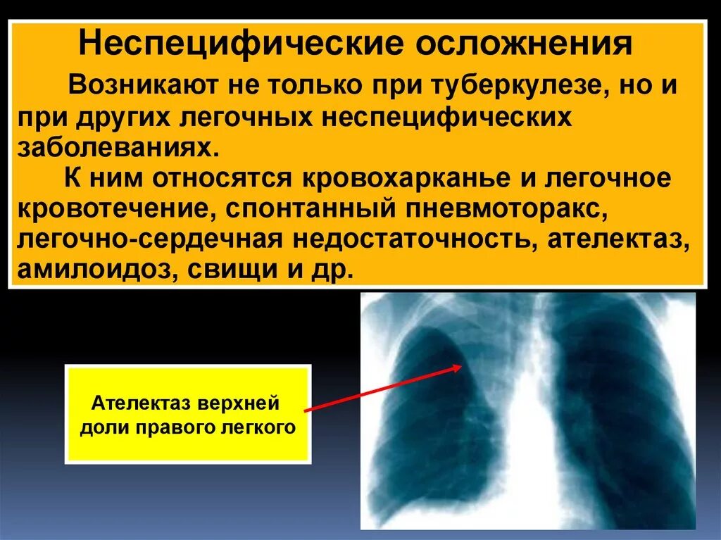 Помощь при туберкулезе легких