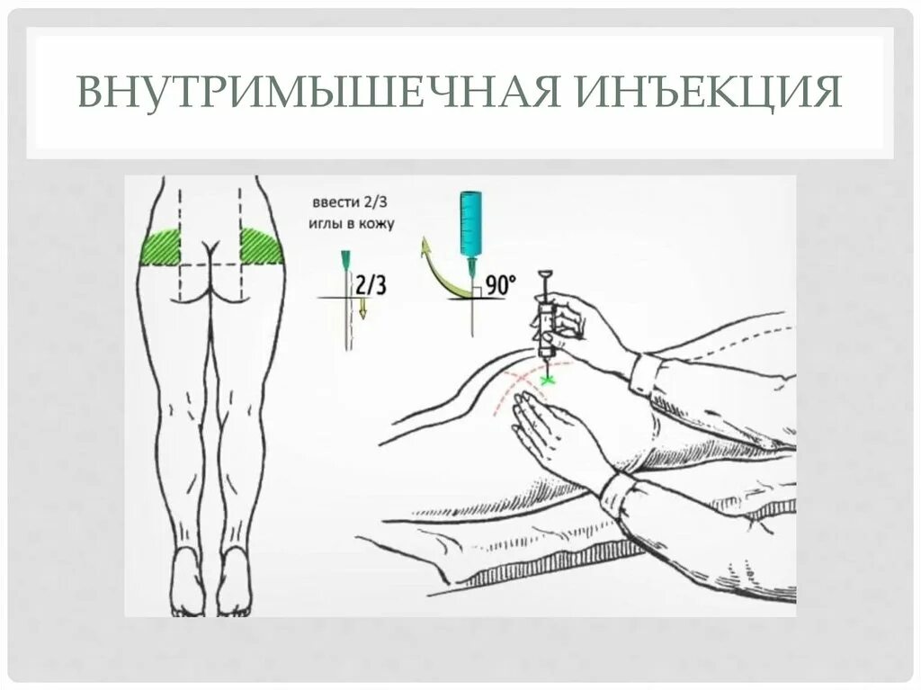 Введение иглы при внутримышечной инъекции. Укол внутримышечно алгоритм. Схема внутримышечной инъекции. Внутримышечная инъекция иглы места. Оснащение для внутримышечной инъекции.