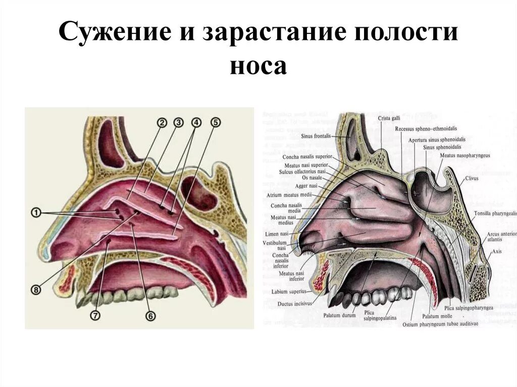 Пазухи носовой полости анатомия. Строение носовой перегородки внутри. Анатомия искривлённой носовой перегородки. Строение носовой перегородки раковина.