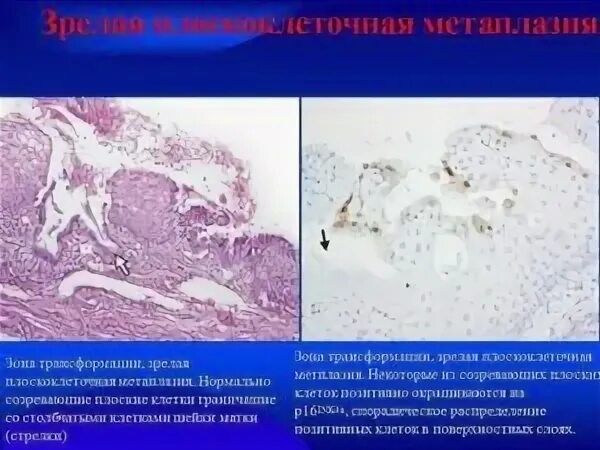 Метаплазированный эпителий шейки матки