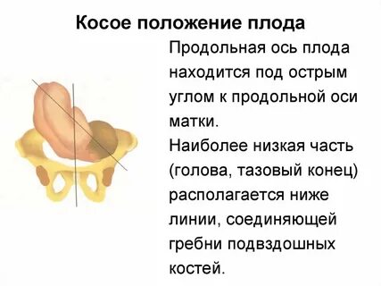 Наклонное положение