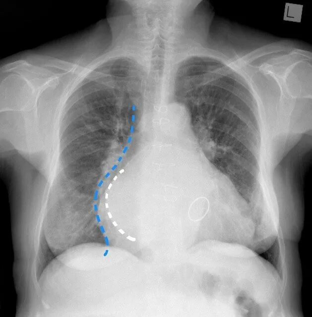 Легочное сердце патанатомия. Гипертрофия легких. Экг при легочной гипертензии. Гипертрофия легких. Легочное сердце снимок.
