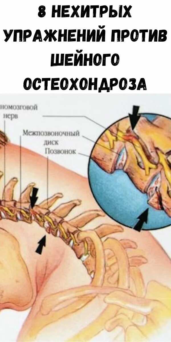 Упражнения против шейного. Упражнения против шейного остеохондроза. Гимнастика против шейного остеохондроза. 8 Упражнений против шейного остеохондроза. Иглоукалывание при остеохондрозе шейного отдела эффективность.