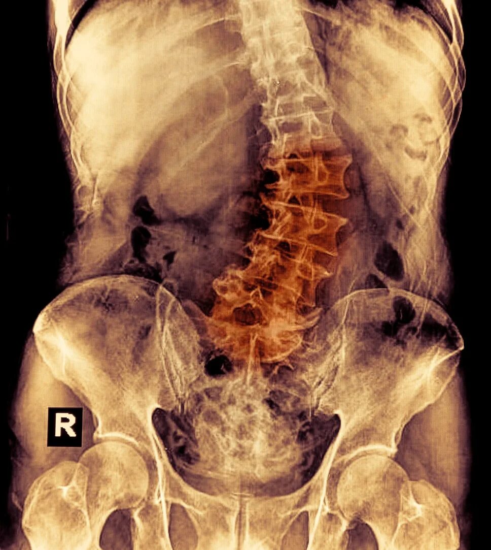 Надорвала поясницу. Рентген пояснично-крестцового отдела. Пояснично крестцовый рентген. Сколиоз поясничного отдела рентген. Сколиоз крестцового отдела.