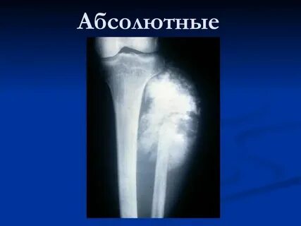 Рак костей симптомы