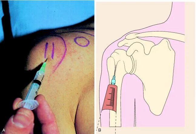 Инъекции в плечевой сустав техника. Внутрисуставной укол в плечевой сустав. Внутрисуставная блокада плечевого сустава. Инъекция в дельтовидную мышцу.