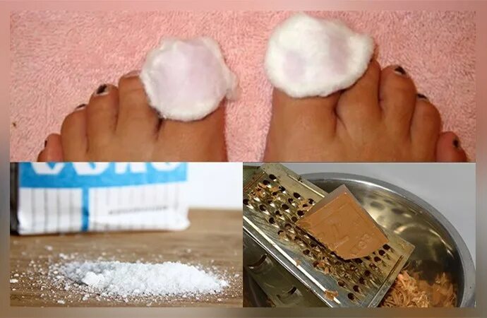 Сода йод мыло. Соль от грибка ногтей на ногах. Дегтярное мыло от грибка ногтей на ногах.