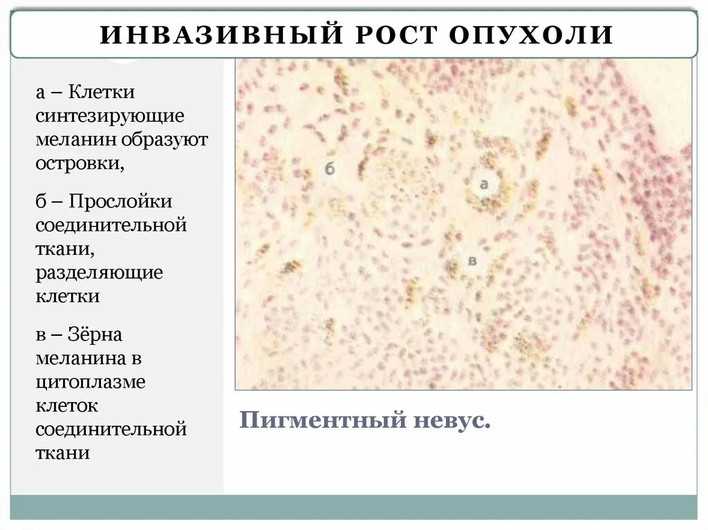 Вид опухолей при различных формах роста. Типы роста опухолей инвазивный. Признаки инвазивного роста опухоли. Этапы инфильтрирующего роста опухоли. Экспансивный рост это