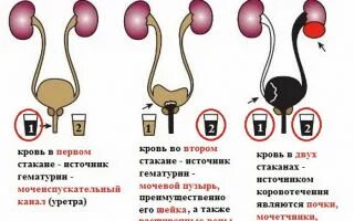 Моча 3-х стаканная проба. Двухстаканная проба мочи. 3х стаканная проба. Трехстаканная проба Томпсона. Трехстаканная проба мочи