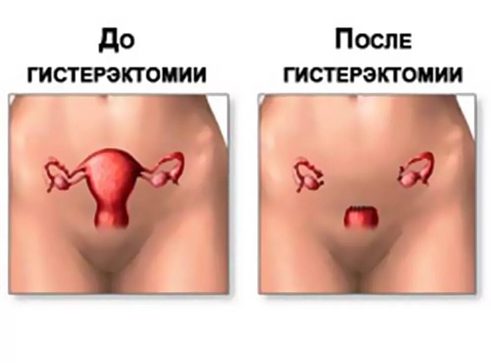 Что такое гистерэктомия. Лапаротомическая гистерэктомия.