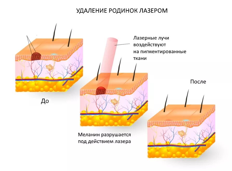 Электрокоагуляция на лице. Иссечение невусов лазером. Электрокоагуляция новообразований кожи. Иссечение родинки лазером. Электрокоагуляция папиллом.