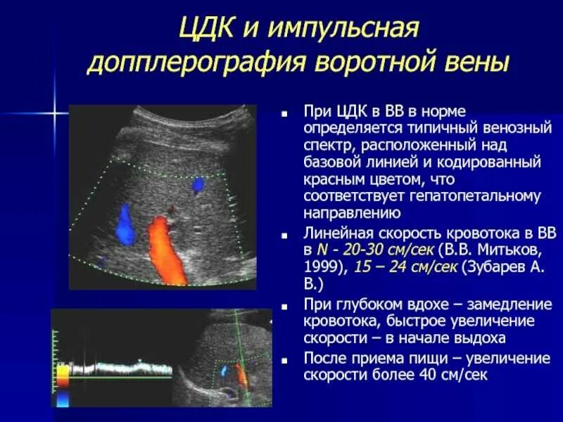 Аваскулярное образование в печени. Импульсная допплерография воротной вены. Воротная Вена на УЗИ норма. Портальная Вена на УЗИ норма. Ультразвуковая допплерография воротной вены.