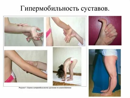 Синдром суставов у детей