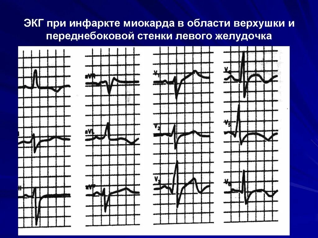 Инфаркт миокарда передней стенки экг. Острый нижний инфаркт миокарда на экг. Инфаркт миокарда передней стенки левого желудочка. Острый трансмуральный инфаркт передней стенки на экг. Острый инфаркт передней стенки левого желудочка.