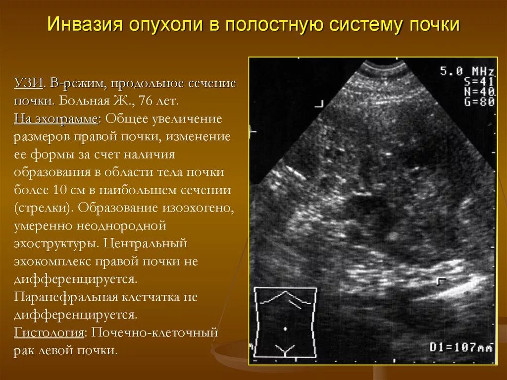 Объемное образование в почке на УЗИ что это. Объёмное образвоание почки УЗИ. Злокачественная опухоль на УЗИ.