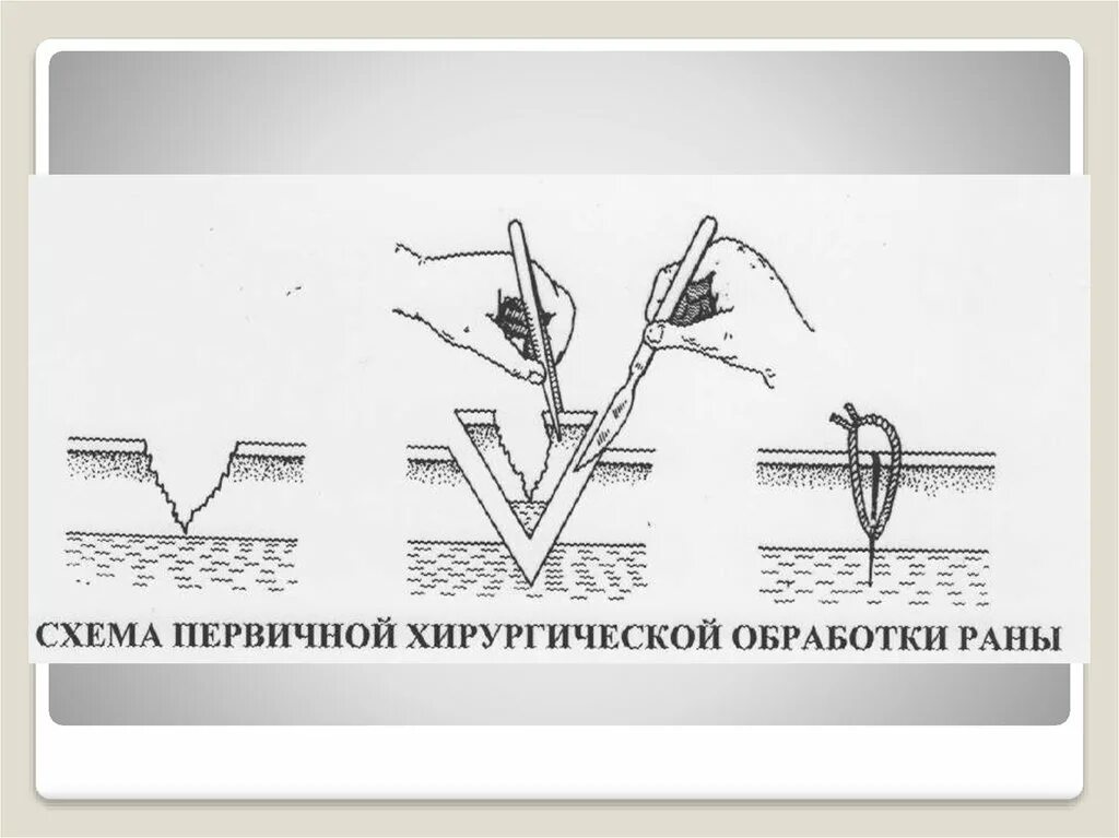 Первичная хирургическая обработка это. Вторичная хирургическая обработка раны схема. Схему первичной хирургической обработки РАН. Принципы Пхо раны.