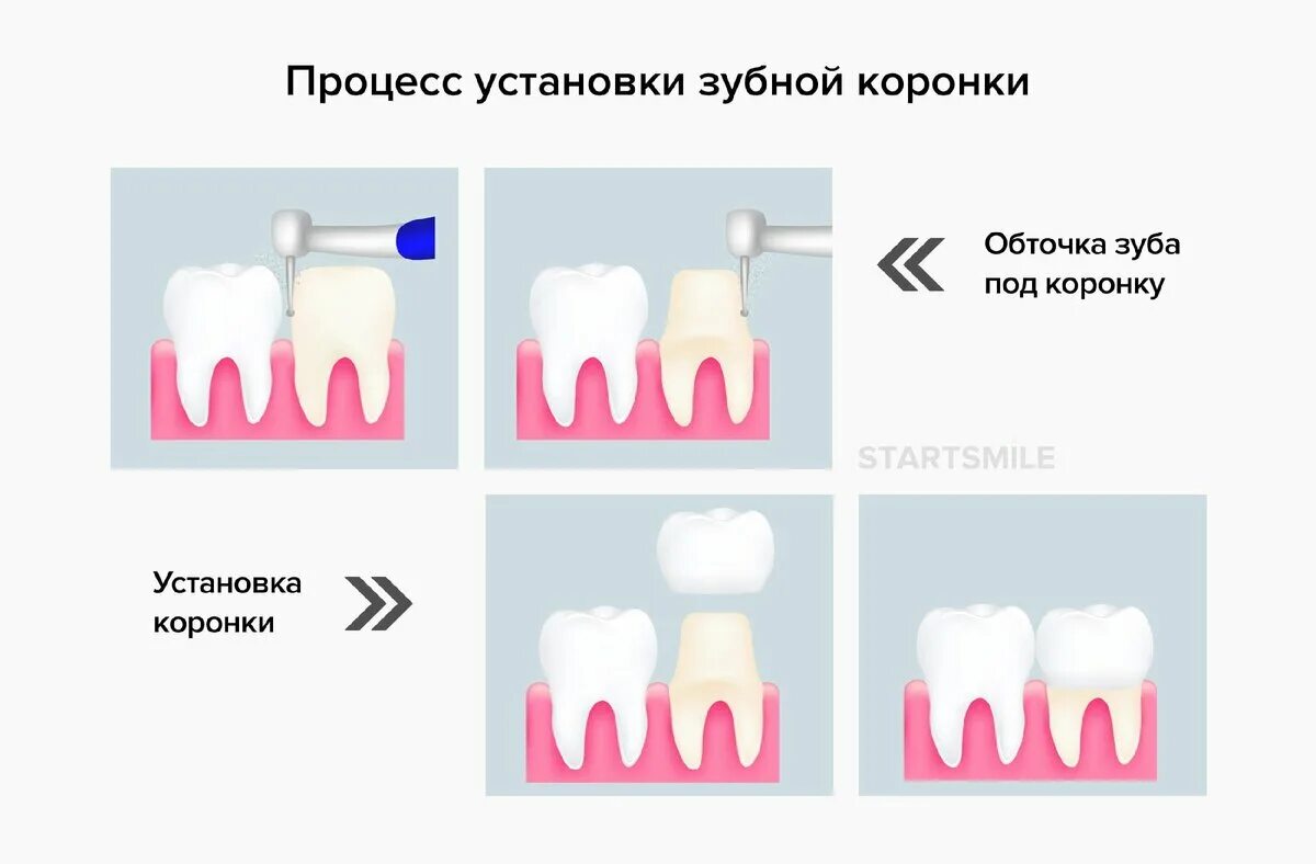 Как устанавливают коронку на зуб. Как устанавливается коронка на зуб. Коронка на зуб схема установки.