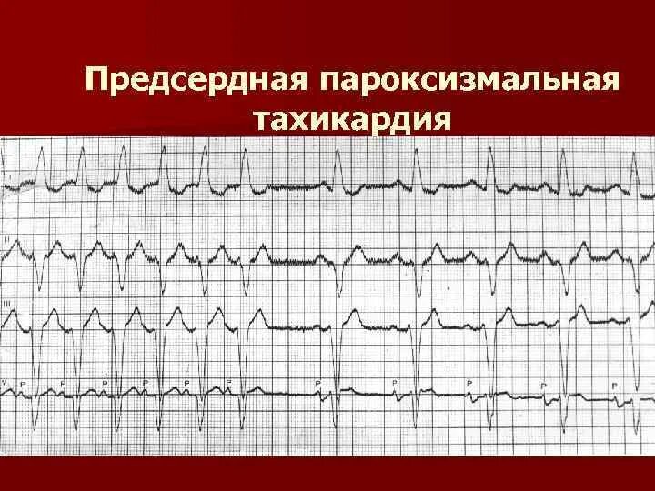 Тахикардия qrs. Экг критерии пароксизмальной суправентрикулярной тахикардии. предсердная пароксизмальная тахикардия на экг. пароксизмальная предсердная аритмия на экг. пароксизмальная тахиаритмия экг.