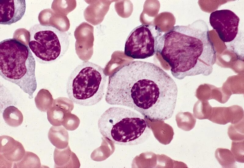 Рефрактерной сидеробластной анемии. Миелодиспластические синдромы классификация. Мдс классификация воз. Миелодиспластический синдром (мдс). Миелодиспластический синдром.