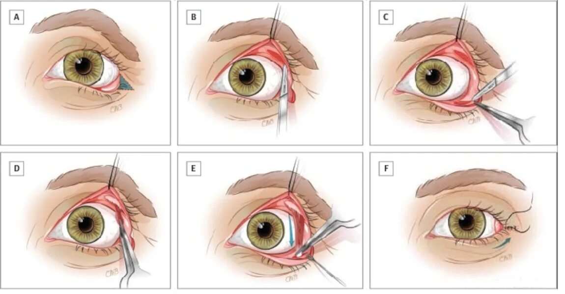 Веки зачем. Эктропион выворот века. Конъюнктивальная блефаропластика нижних век. Блефаропластика нижних век схема операции. Коньюктивита блефаропластика нижних век.
