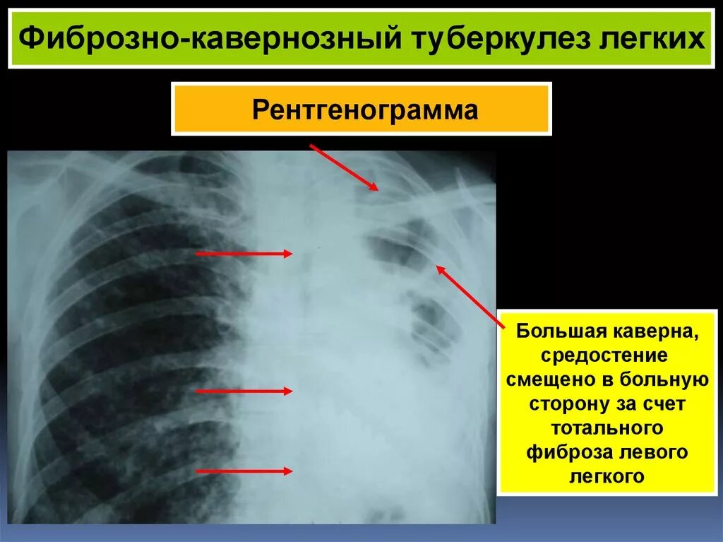 Умеренные фиброзные изменения