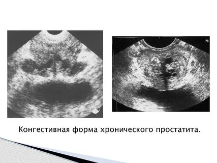 Простатит узи