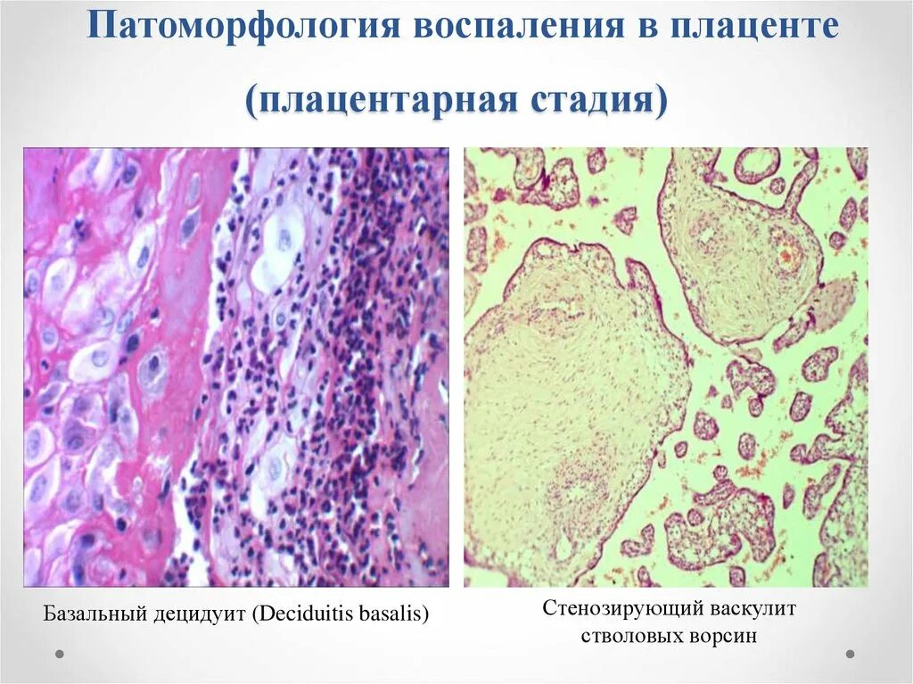 Хронический децидуит гистология что это. Хориодецидуит плаценты Гнойный гистология. Воспаление последа микропрепарат. Патология плаценты микропрепараты.