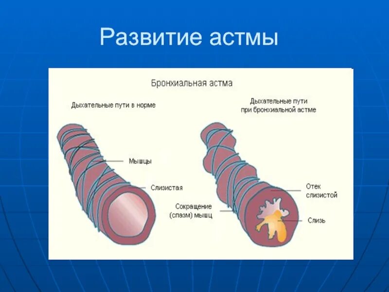 Как развивается астма. Астма. бронхиальная астма. бронхиальная астма презентация. легкие при бронхиальной астме.